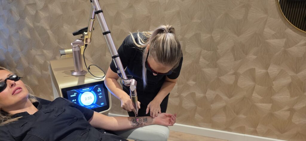 Laserbehandeling voor tattoo verwijderen in Apeldoorn